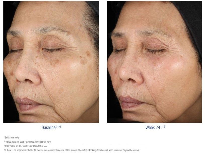 obagi nu derm retinol