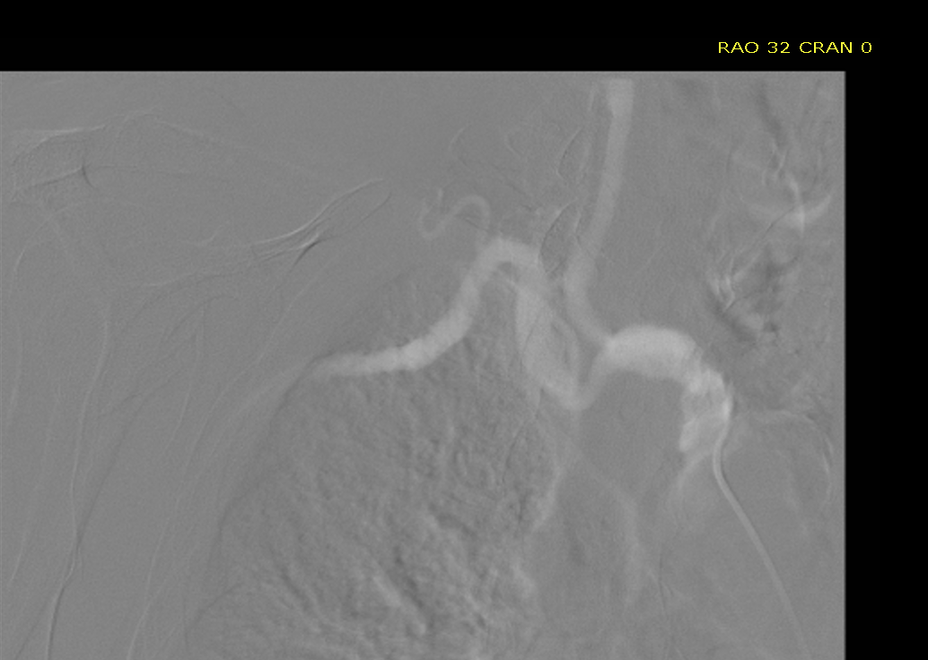 Patient with no femoral access, severe ostial left subclavian disease, EF 20%, needs MV/LM PCI. Is this right subclavian too tortuous for axillary impella? @ProtectedPCI #cardiotwitter @CleveClinicCath