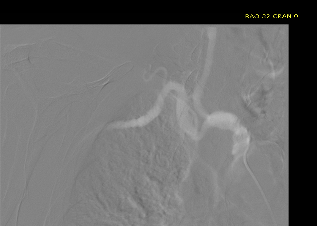 Jeffrey Rossi (@jrossimd) on Twitter photo Patient with no femoral access, severe ostial left subclavian disease, EF 20%, needs MV/LM PCI. Is this right subclavian too tortuous for axillary impella? <a href="/ProtectedPCI/">Protected PCI</a> #cardiotwitter <a href="/CleveClinicCath/">Cleveland Clinic Cath Lab</a> Patient with no femoral access, severe ostial left subclavian disease, EF 20%, needs MV/LM PCI. Is this right subclavian too tortuous for axillary impella? <a href="/ProtectedPCI/">Protected PCI</a> #cardiotwitter <a href="/CleveClinicCath/">Cleveland Clinic Cath Lab</a>