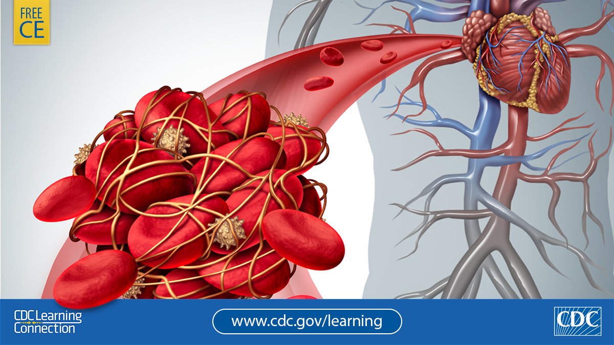 HCPs: You can help prevent blood clots! Learn how to manage patients with blood clots and clotting disorders in @StopTheClot’s training. Free CE. bit.ly/2tDW7Go 
#CDCLearning @CDC_NCBDDD