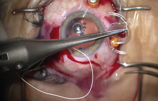eyetubenet's tweet photo. Brandon Ayres, MD, shows an exchange of a trifocal implant due to retained cortex and a posterior capsular tear. Watch here: https://t.co/SshInAoZNZ #Ophthalmology #IOLexchange https://t.co/E6uWYkq4nz