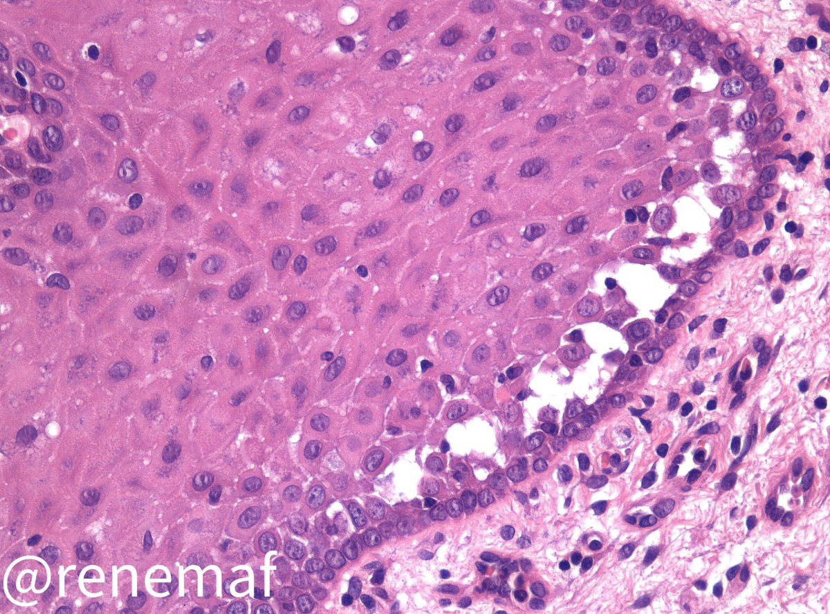 Almost always to take a biopsy of a vesiculobullous lesion is a challenge and getting a good quality slide is an even greater challenge. 46-yo female with chronic ulcers on cheek and soft palate mucosa, Nikolsky sign (+). #oralpath #oralpathology #dentistandpathologist