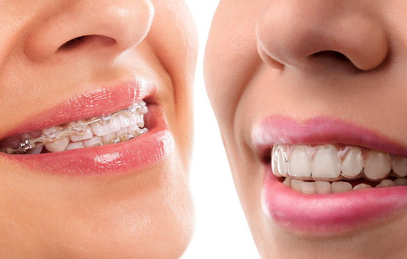 Braces or Aligners