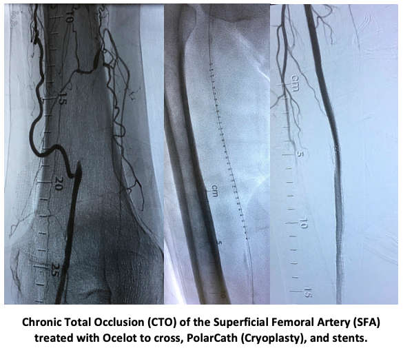 nucryo's tweet photo. Great first case with  Dr. Thomas Khoury at South Ohio Medical Center (SOMC) involving complementary technologies of Ocelot (@AvingerInc), PolarCath (@nucryo) and stents!   #CLI #CTO #PAD #results #data https://t.co/UkP1XA9aOo