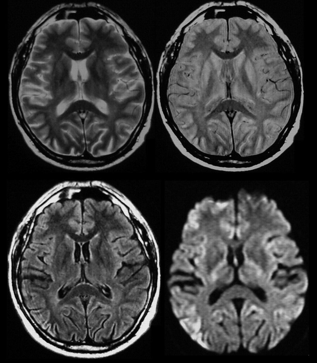 JakePre52165680's tweet photo. Submit your abstract towards #Neuroscience2020
#CreutzfeldtJakobdisease is a #fatal #degenerative #brain #disorder. Early symptoms include #memory problems, #behavioralchanges #poorcoordination, and #visual #disturbances.
More: https://t.co/3nxKDx1O4p
#neuroscienceconference https://t.co/D7RvUHAt0M