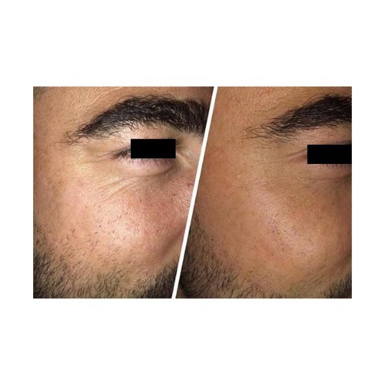 OpAestheticsRT's tweet photo. Here is an example of the amazing effects @RadaraUK has on fine lines and wrinkles.
The picture speaks for itself!
Do you have some fine lines and wrinkles you want gone? DM me to find out more or visit my website!

#Wrinkles #Radara #finelines #aesthetics #ACEgroupmember https://t.co/4BpSfK9fWO