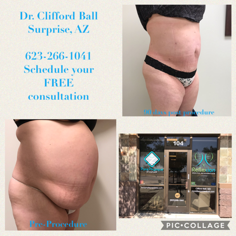 Here is a before and after transformation of one of our lovely patients undergoing High Definition (HD) Body Contouring! #body #transformation #medtwitter