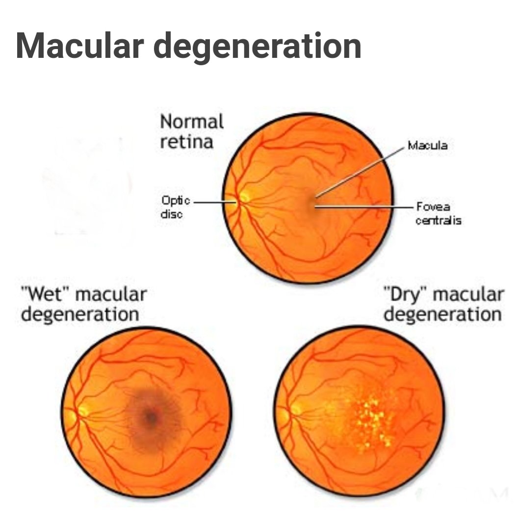 New treatment for dry macular degeneration 2020