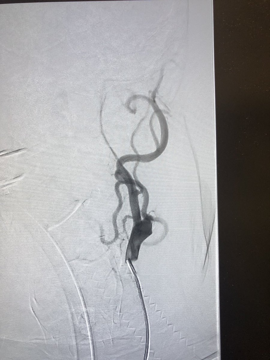 RLHINR's tweet photo. From occluded ICA to TICI 3 reperfusion. #MIVI #Q6 #aspiration for the win. #MT #leavenostrokebehind #spectrumstroke #alotofclot https://t.co/Xvni70QpAu