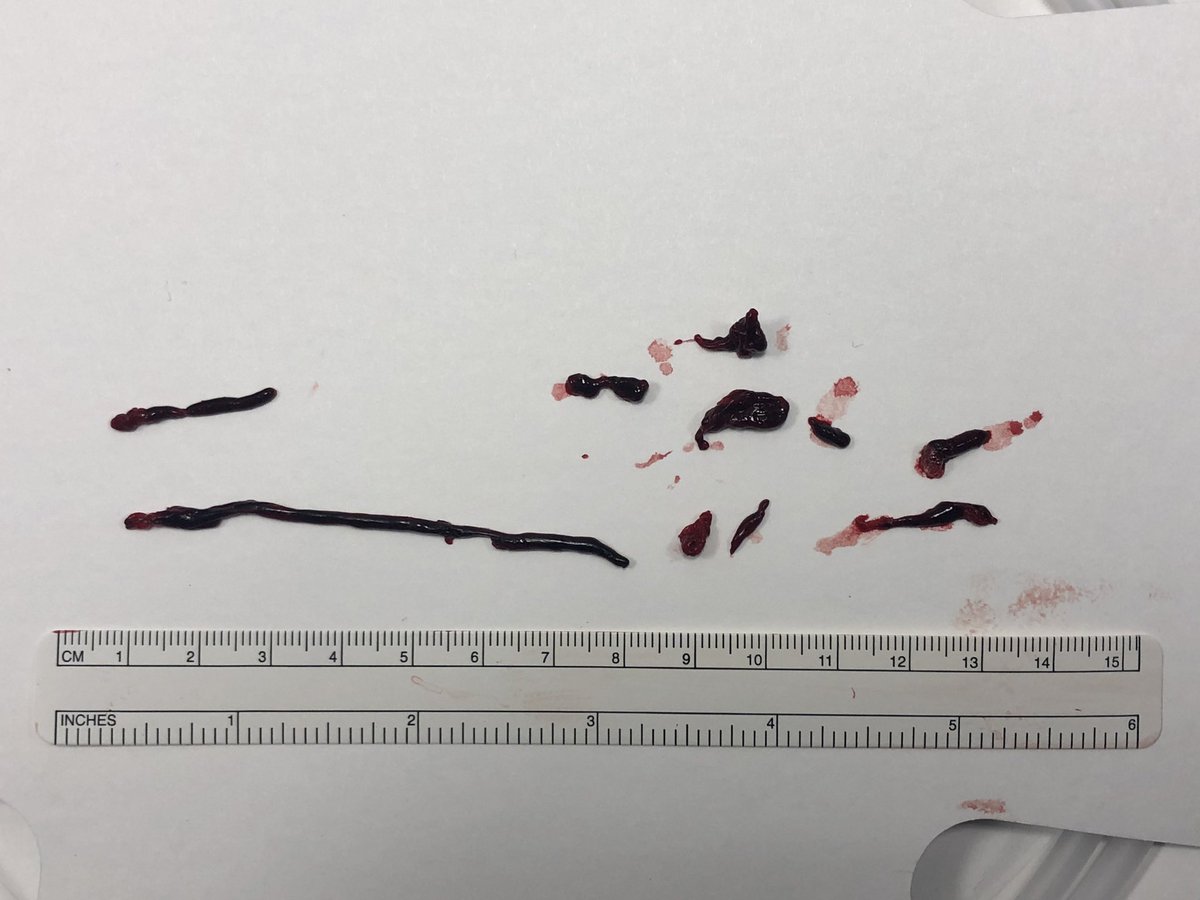 RLHINR's tweet photo. From occluded ICA to TICI 3 reperfusion. #MIVI #Q6 #aspiration for the win. #MT #leavenostrokebehind #spectrumstroke #alotofclot https://t.co/Xvni70QpAu