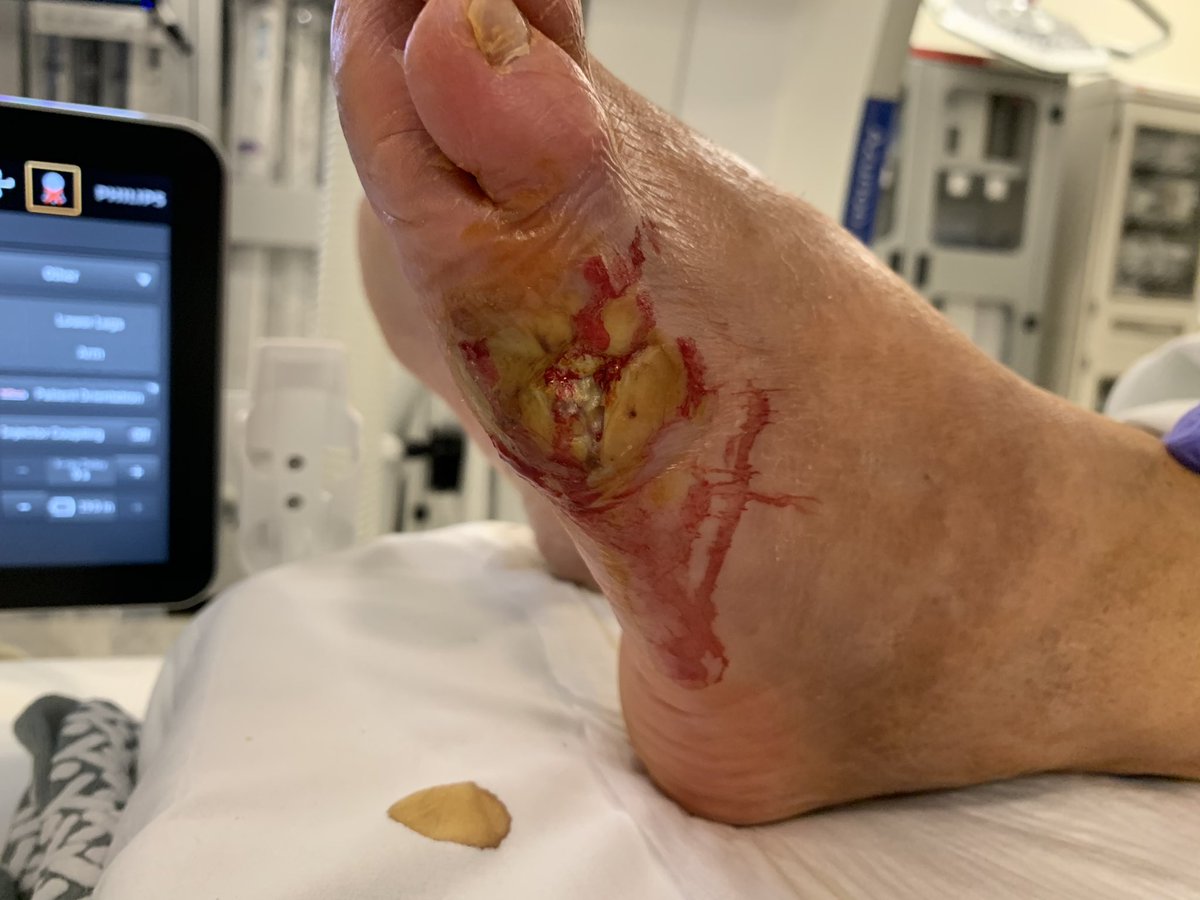 60M T2DM, recurrent left lateral foot ulcer despite new shoes, seen several specialists, desperate for relief.  #pedal loop reconstruction and nerve block per pt request. #clifighter @NorthwesternIR Lake Forest.  @CarlosGuevaraIR @JVIRmedia @WashUIR @kmadass