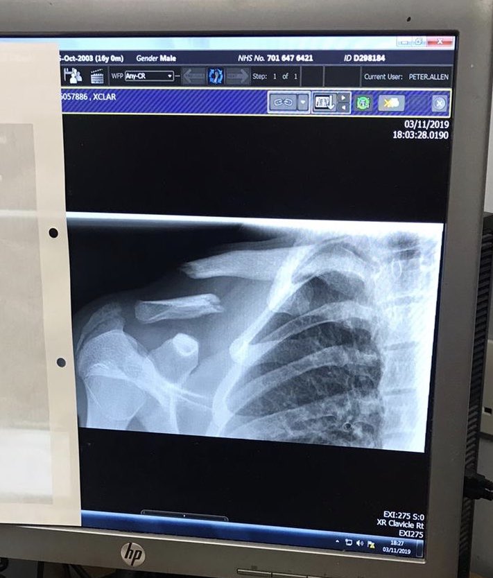 JohnGalley99's tweet photo. Looking forward to my lad being in the squad tomorrow for @GwcyfcU16 1/4 final cup game after 4 months out with a broken collar bone.
6 screws &amp; a titanium plate later he is buzzing to be named on the bench &amp; hopefully will get a few minutes of match time
#letsdothis #ProudDad https://t.co/2kkmBEesdk