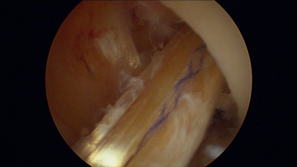 RodillaCEMTRO's tweet photo. Plastia LCA, reinserciรณn raรญz meniscal! Sรกbado de sportmedicine! #meniscalroot #aclsurgery @ClinicaCEMTRO @SETRADEORG @RodillaCEMTRO @CarlosColmene14 @DrSanzZapata @chuma1985 https://t.co/DuyO3r43OJ