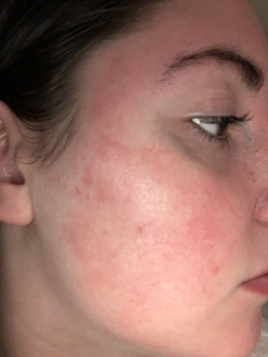 laurenpoulin13's tweet photo. Update: be careful, always do a patch test https://t.co/tTKUuuPFnW