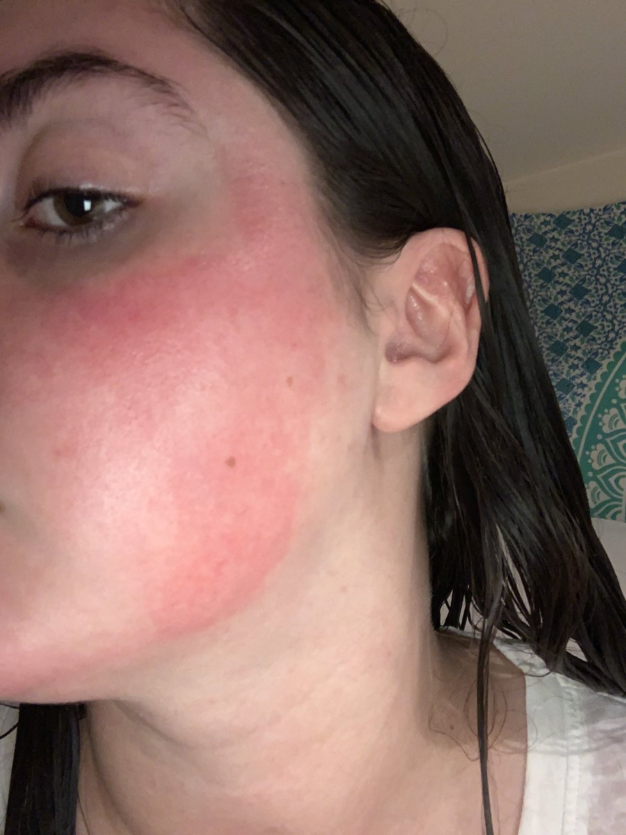 laurenpoulin13's tweet photo. Update: be careful, always do a patch test https://t.co/tTKUuuPFnW