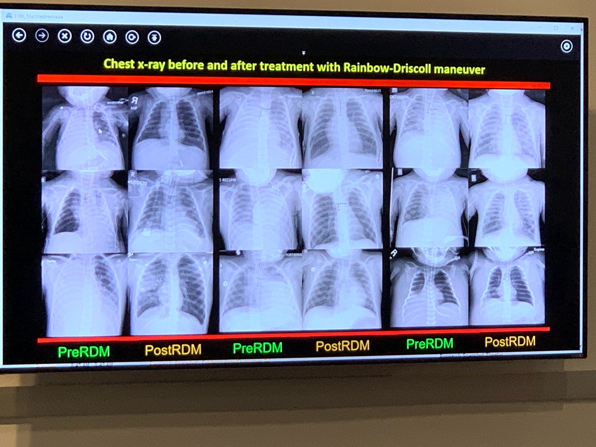 RBC_PICU's tweet photo. Intubated patient in the #PedsICU ?  White-out on CXR? Check out the @AlexRotta “Rainbow Driscoll” maneuver as presented by @UHRainbowBabies Fellow Alejo Martinez at #CCC49 https://t.co/lIhlNbLFpI