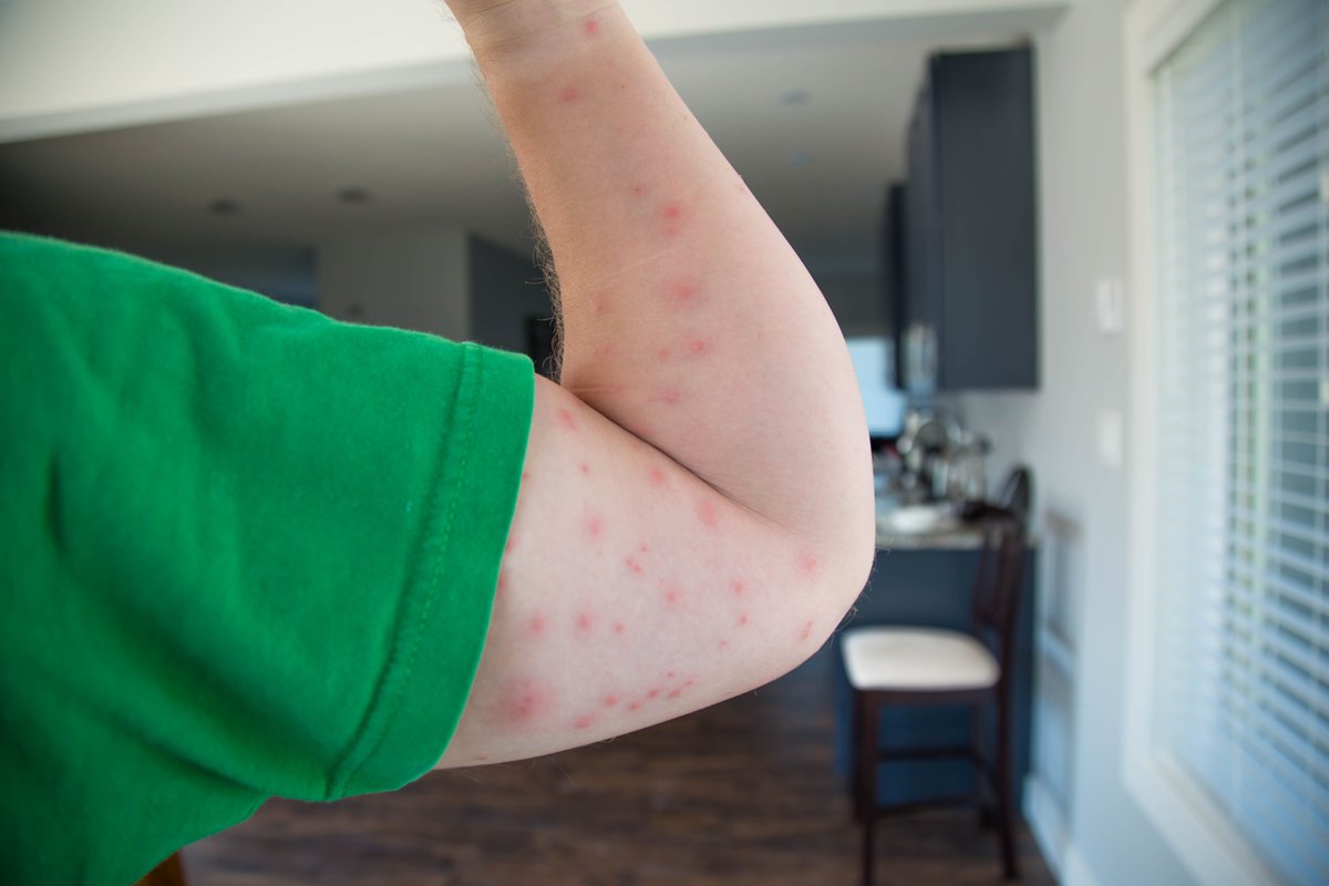 WatchdogPest's tweet photo. Bed bugs can be very insidious! Check out our blog entry on how to identify their bites here - https://t.co/3G1gH8Ouoi

#pest #pests #pestcontrol #pestcontrolaz #pestcontrolservices #pestsolutions #diypestcontrol #bedbug #bedbugs #bedbugcontrol #bedbugphotography #insect #insects https://t.co/Y6tcIIxWDd
