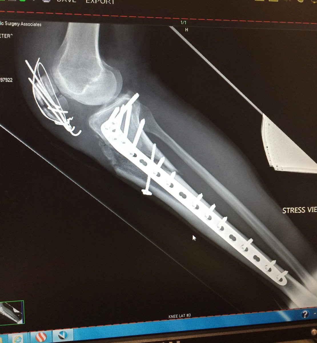 peterstetina's tweet photo. That is my x-ray in 2015.
Podcastππ with a unique angle.
I sat down with @EricDMarcotte (former USA road champ and bad ass chiropractor) for his OEM podcast. We talk #gravel, the #PimpLimpπ, health, #rehab, & #physicaltherapy https://t.co/LpWuvZtZSR https://t.co/2IsRdwvFa7