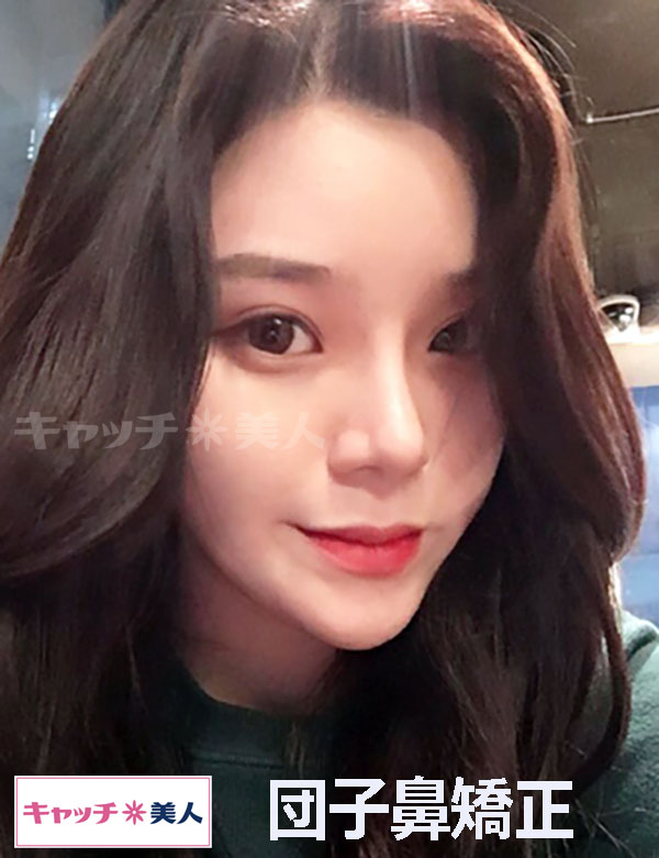 توییتر キャッチ美人 韓国整形美容サポート در توییتر 手術内容 団子鼻矯正 手術病院 ラミチェ美容外科 太ってる団子鼻を細くてスリムな感じに 詳しい相談はキャッチ美人までお願い致します T Co Q2puotsevx ラミチェ美容外科