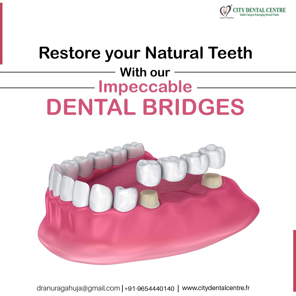 cdc_europe's tweet photo. Dental bridges are a great way to restore the mouth’s chewing and speaking functionality as we replace one or more missing teeth with custom-fit artificial teeth and dental crowns. Avail world class treatment at any of our dental care centre. Book an appointment today! https://t.co/9XRpoI5Hte