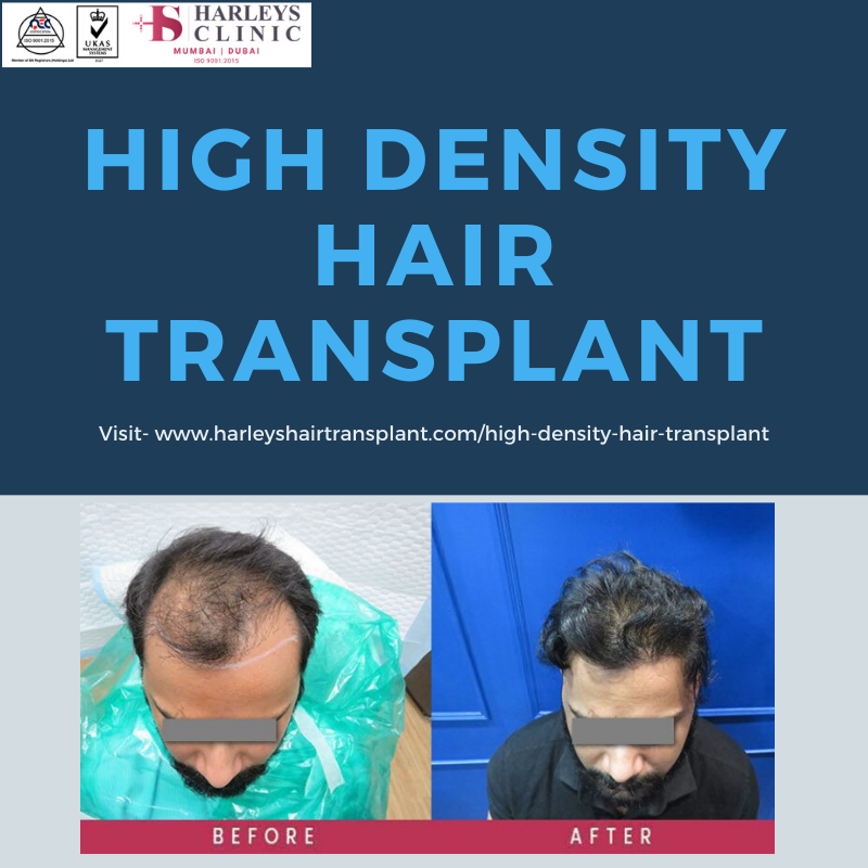 sunidhi39's tweet photo. Ultra #highdensityhairtransplant is possible with Harley’s #hairtransplantinMumbai as we use the latest technology for all hair transplant procedures. 
For more information please visit- https://t.co/mSvk1l7A3r https://t.co/mv0fodX1ix