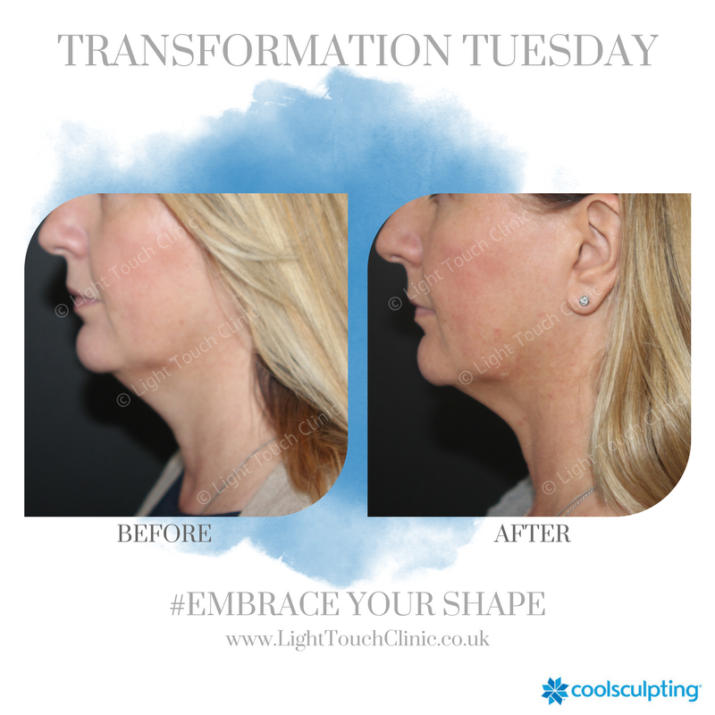 lightouchclinic's tweet photo. Eliminate stubborn fat with CoolSculpting❄️ We can specifically target those hard to get rid of areas with our specialist applicators.

To book a consultation and see what CoolSculpting can do for you, get in touch!

📞- 01932 849552
✉️- info@lighttouchclinic.co.uk https://t.co/wsG6FVFINq