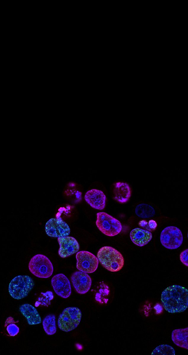 longitude_prize's tweet photo. New study released today by @longitude_prize reveals that 95% of UK oncologists are worried about the impact of #superbugs on their #cancer patients. More #AMR news here:  https://t.co/XEqXI2olol https://t.co/kJJXaSg5HY