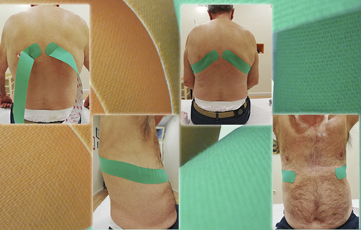 Temtex_Es's tweet photo. Técnica para el Dolor Crónico Post Fractura Costal

Nos hacemos eco de una Aplicación de Vendaje Neuromuscular que Pretende Reducir el Dolor en la Parrilla Costal Posterior
#temtex #vendajeneuromuscular #kinesiotaping

➡️https://t.co/fZCVd6wtlY https://t.co/bJimvRTjPQ