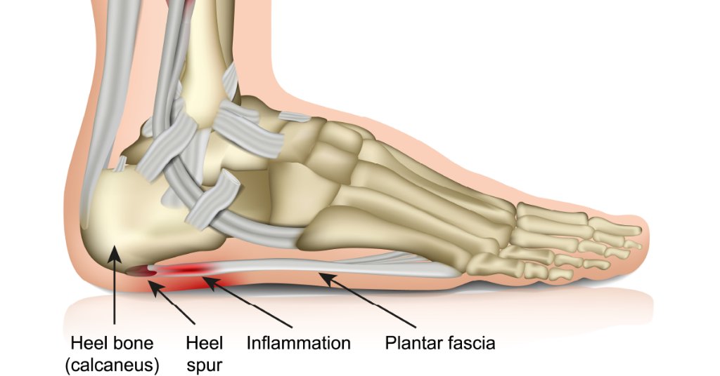 webmd heel spur