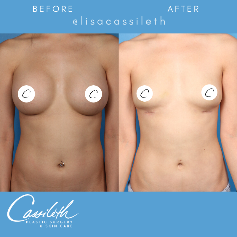 cassileth's tweet photo. #transformationtuesday 📸  
​This lovely patient wanted her breast implants removed after years of having them in. Dr. Cassileth performed bilateral breast implant removal with pectoral muscle repair &amp; fat grafting and the results are beautiful and natural. 😍 #beforeandafter https://t.co/054dI7LOzx