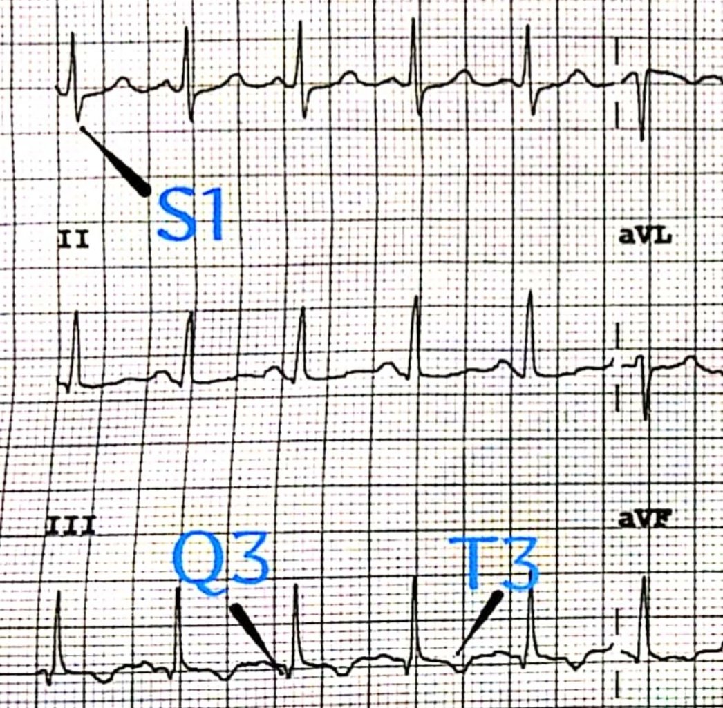 Daniel Uribe  El Plejo De Mcginn White O Patron S1q3t3 S En Di Q En Diii Y T Negativa En Diii Es Indicativo De Hipertension Pulmonar Con Dilatacion Ventricular Derecha Originando Cor