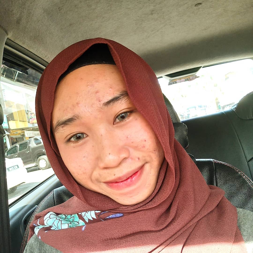 hazidajimmy's tweet photo. Hi, i just wanna tell you guys that #ACNEISNORMAL okay ? https://t.co/gqpD7gUPLp