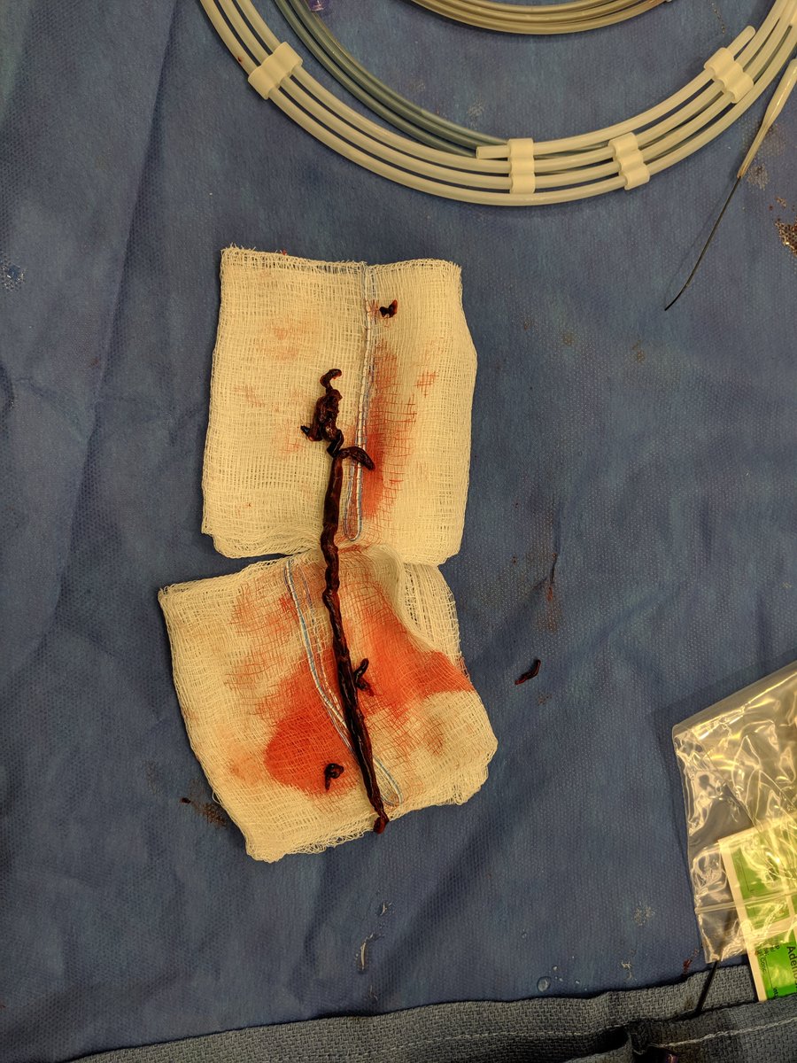James Katrivesis, MD (@jkatrivesismd) on Twitter photo Early experience with FlowTriever. Saddle PE came out in like one long piece wow! #PE #irad <a href="/SIRRFS/">SIR RFS</a> <a href="/SIRspecialists/">Society of Interventional Radiology</a> <a href="/PERTConsortium/">The PERT Consortium®</a> Early experience with FlowTriever. Saddle PE came out in like one long piece wow! #PE #irad <a href="/SIRRFS/">SIR RFS</a> <a href="/SIRspecialists/">Society of Interventional Radiology</a> <a href="/PERTConsortium/">The PERT Consortium®</a>