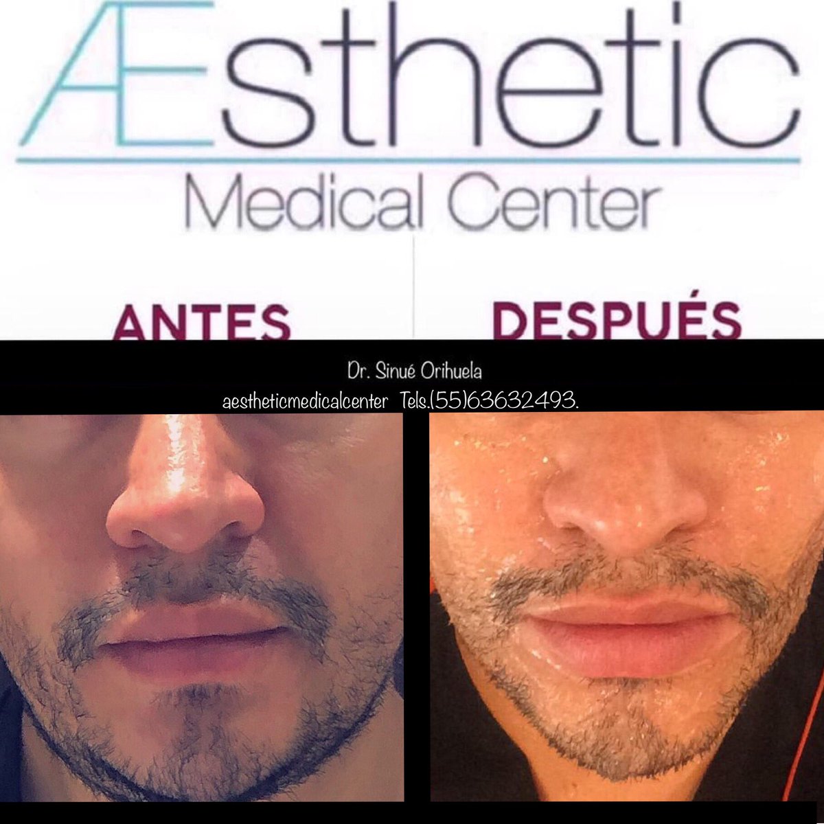 AestheticMC's tweet photo. El #rellenodementón con #acidohialuronico es la mejor opción para elevar y eliminar el #mentón retraído, ofreciendo un aspecto equilibrado y natural al #rostro.
#medicoestetico #rejuvecimiento #paraellosyellas #fillers #sinuéorihuelagarcia #teosyal #rellenosfaciles #liftingfacial https://t.co/qqpDR0r7Mw