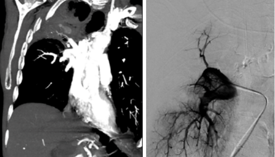 GEST -Global Embolization Symposium & Technologies tweet media