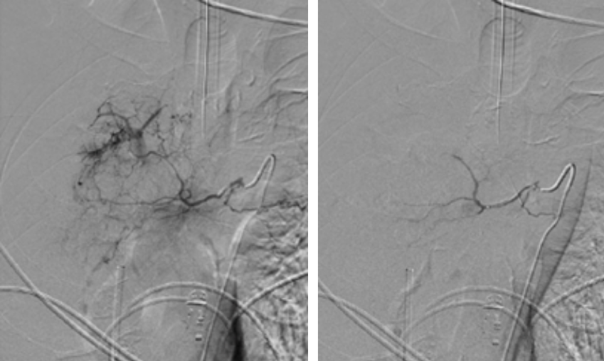 GEST -Global Embolization Symposium & Technologies tweet media