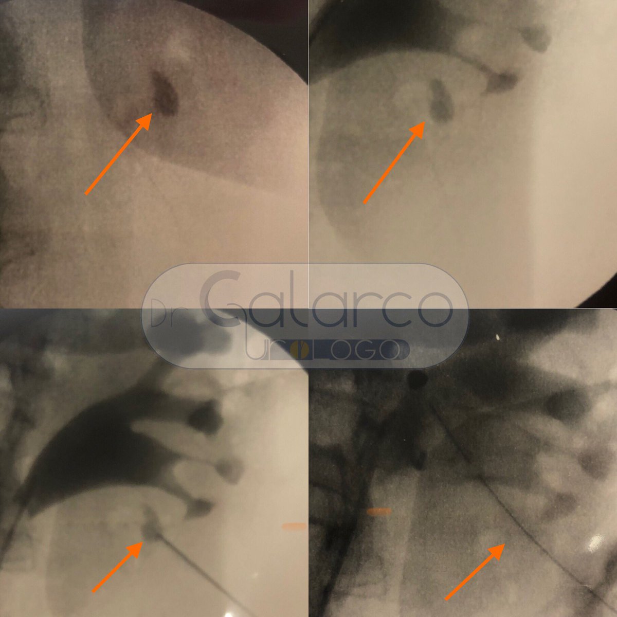 AleCALARCO's tweet photo. What would you do in a stone into an excluded calix? #pcnl #urosome #stone #cookuro #karlstorz #bostonscientific #stonefree https://t.co/EDiZ6DwErE