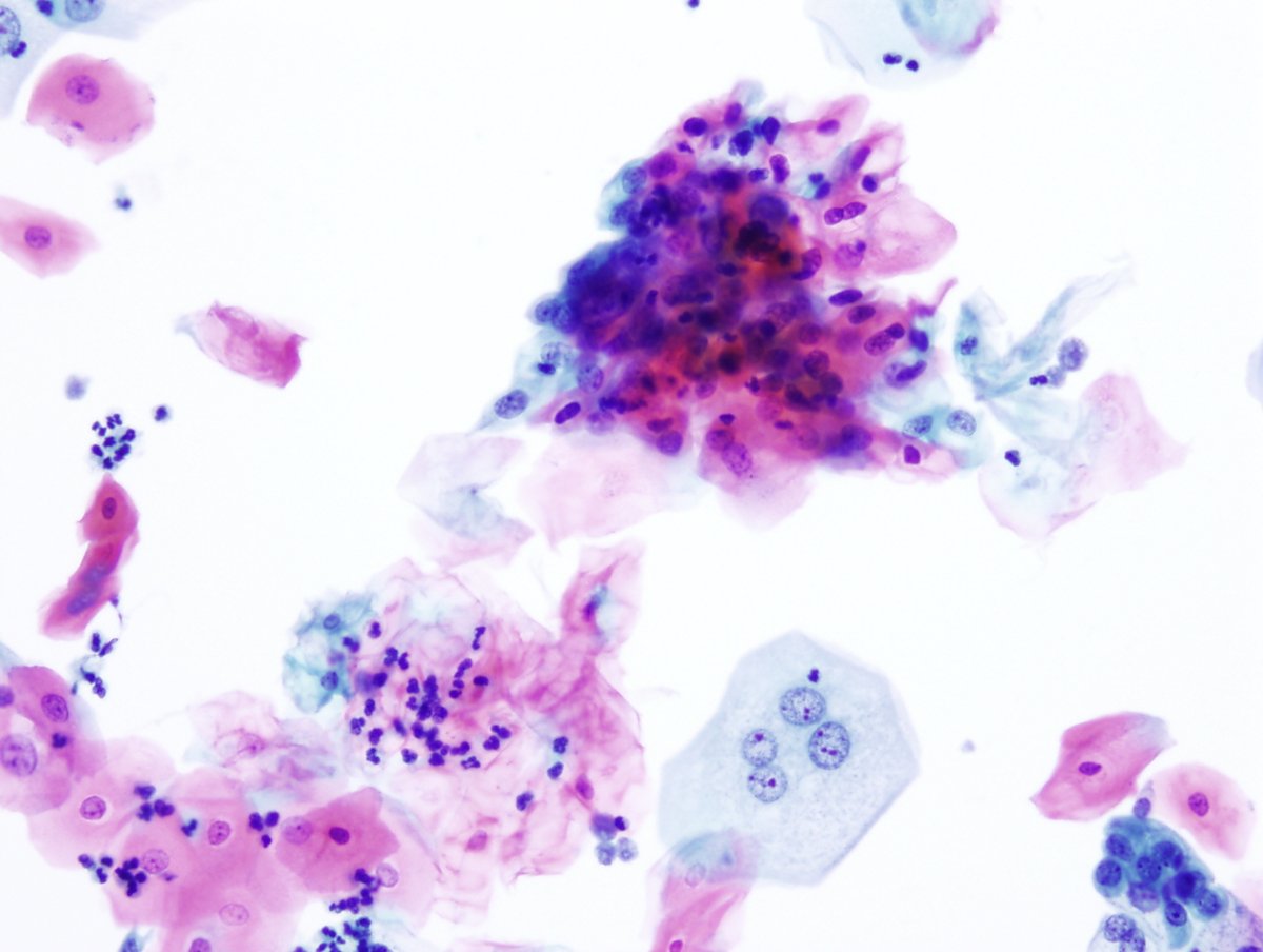 ParisSystem2's tweet photo. Bladder washing from a 56 year old man with intermittent dysuria and papillary lesion in the bladder shows numerous dysplastic squamous cells. Which diagnostic category of the Paris System should be applied? #ParisSystem (see below photos and poll) https://t.co/w7iekiAvx8