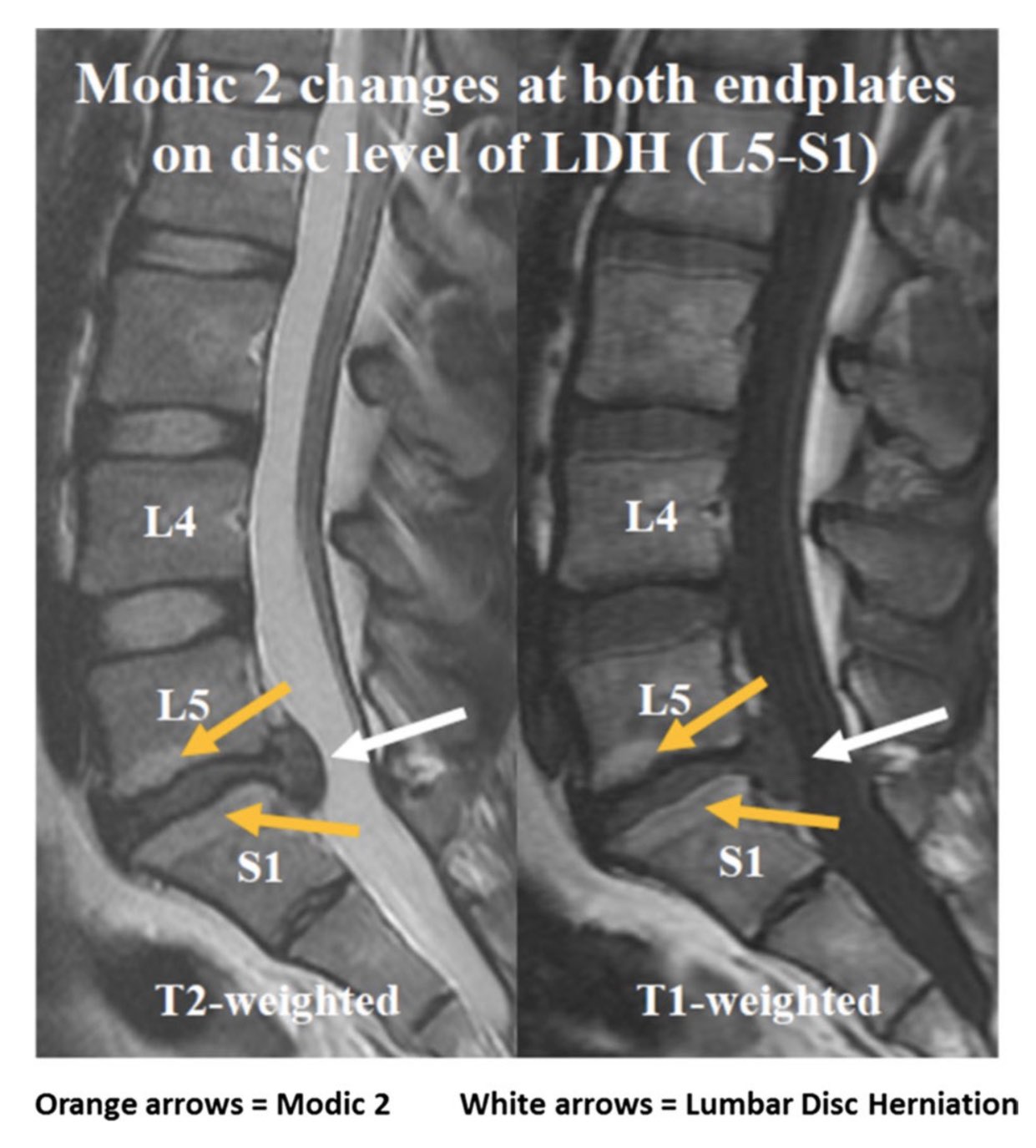Нарушение статики l5 s1. Экструзия диска l5-s1 что это такое. Протрузия диска l2-l3 l5-s1. Нарушение статики l5 s1. Нарушение статики l5 s1.