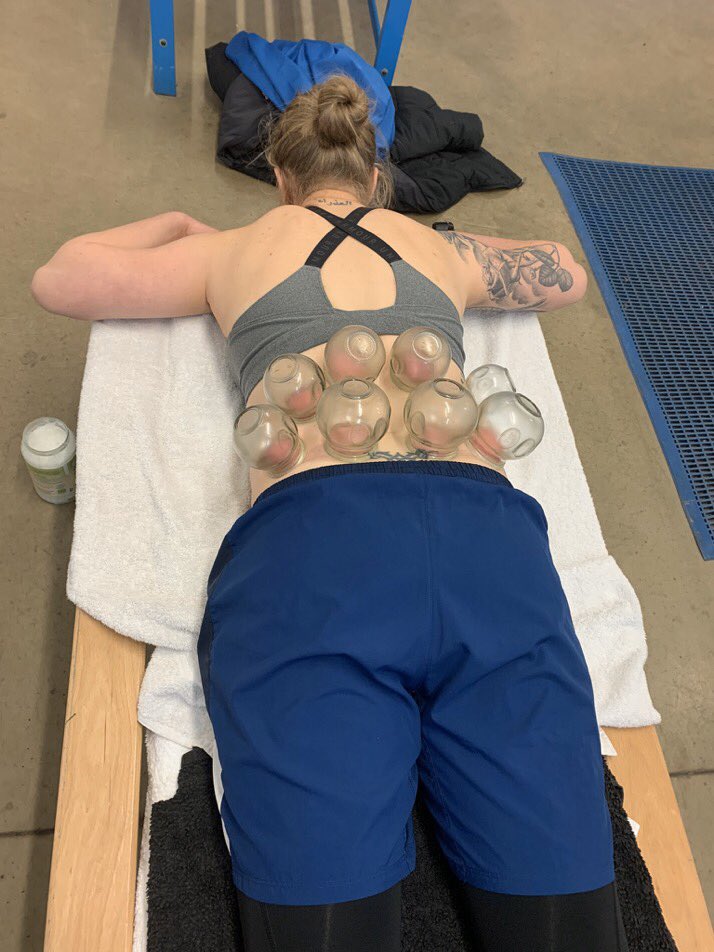 htlfc_Lcarter1's tweet photo. Would like to thank @Kavanagh1994 for sorting me out with some fire cupping tonight and helping with my recovery.100% recommend this guy π #getmebackonthatpitch #recovery https://t.co/Y55xIVGBQi