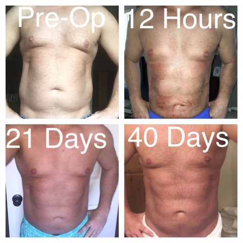 Hey guys, #bodycontouring is not just for women! Check out these results of one of my male patients. His results are astounding! Thinking, “why can’t I look like that?” You can! Check out our website for more information: ow.ly/tlXN30qi40q #medtwitter