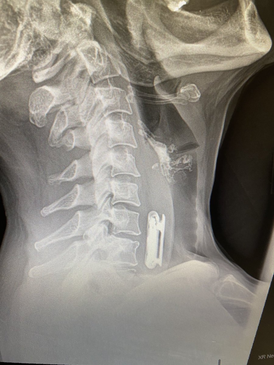 What’s wrong with this X-ray?

For a bonus point, what is it?