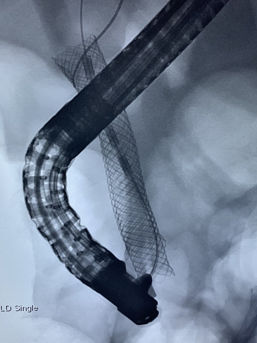 GiorgiaAla's tweet photo. Excellent first-ever #Endobiliary #RFA case at St. Thomas’ hospital on Mon with the #STARmed / ⁦@taewoongmedical⁩ Endobiliary RFA kit - #ELRA - which is temperature-controlled, so absolutely safe.
Contact me for more info! 👌🏼😊

#iRad #Endoscopy #ERCP ⁦@AquilantGI⁩ https://t.co/ipyHSAmAXF