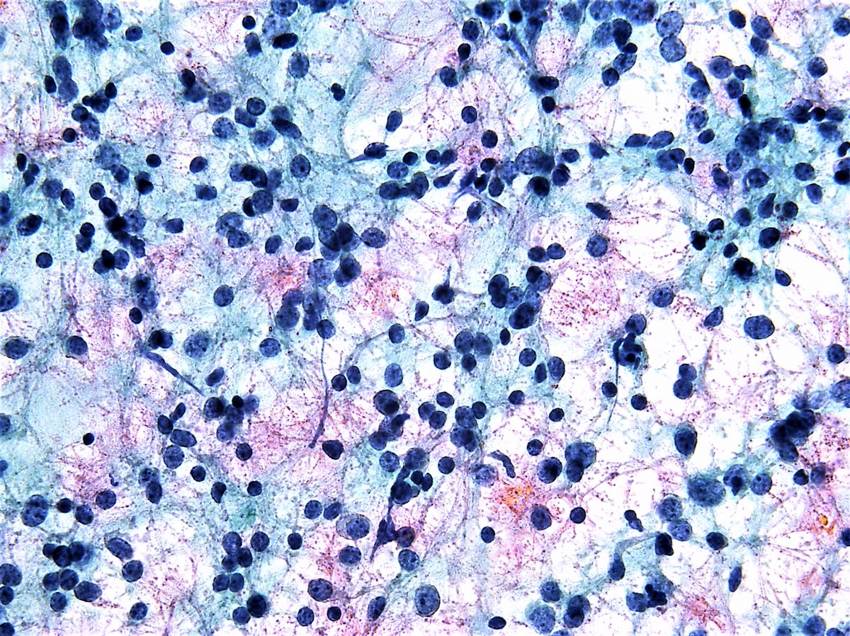 Гистиоциты в цитологии. Гистиоциты гистология. Олигодендроглиома микропрепарат. Гистиоциты цвет. Гистиоциты в цитологии.