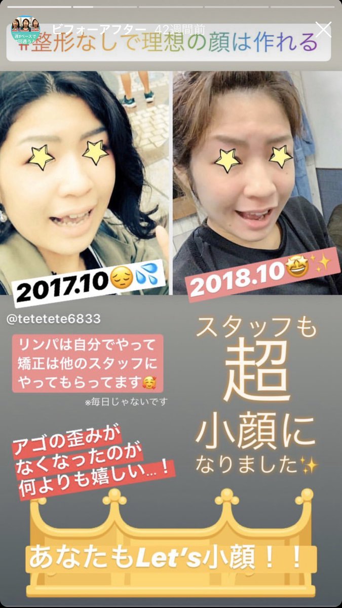 テテ島 小顔矯正スタッフ Tetetete0625 Twitter