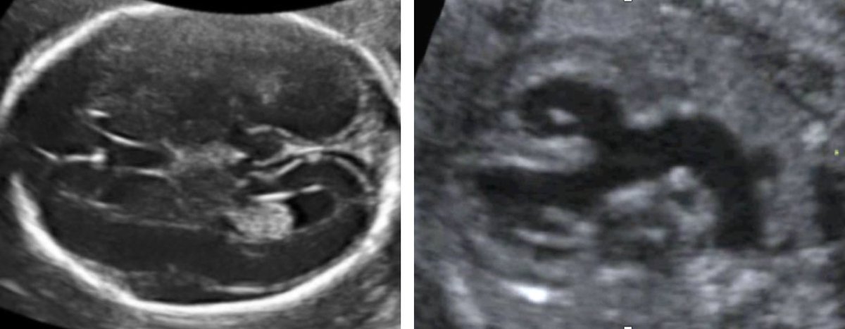 ISUOG's tweet photo. Smaller head circumference in fetuses with congenital heart defect appears to be associated strongly with additional pathology. https://t.co/G5YSD4z8ZV #UOGJournal

Become an #ISUOG Journal member and read the #WhiteJournal: https://t.co/4oCPOvRME1 #LoveUltrasound https://t.co/H2OzFVnd1i