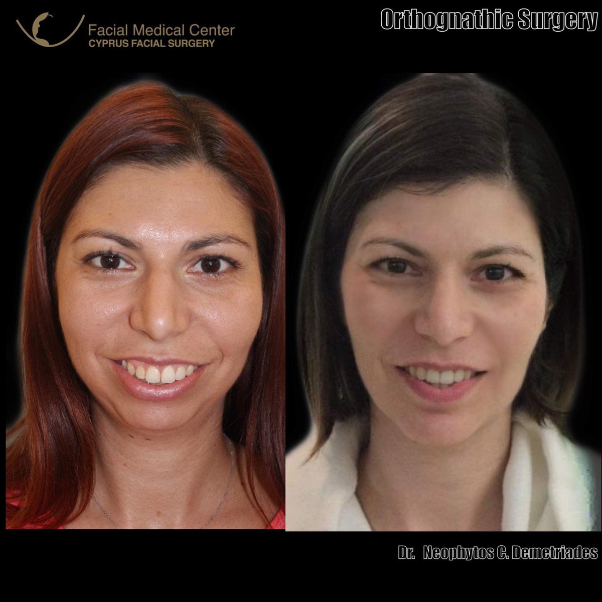 DemetriadesNeo's tweet photo. #cyprusfacialsurgery #facialcosmeticsurgery #oralandmaxillofacialsurgery #DrNeophytosDemetriades 
#weloveyourfacemorethanyoudo
#orthognathicsurgery  #facialcosmeticsurgerycyprus #jawcorrection #jawsurgery #newstylelift #facelift #nosejob #fillers #blepharoplasty https://t.co/ERrZ7iVNvr