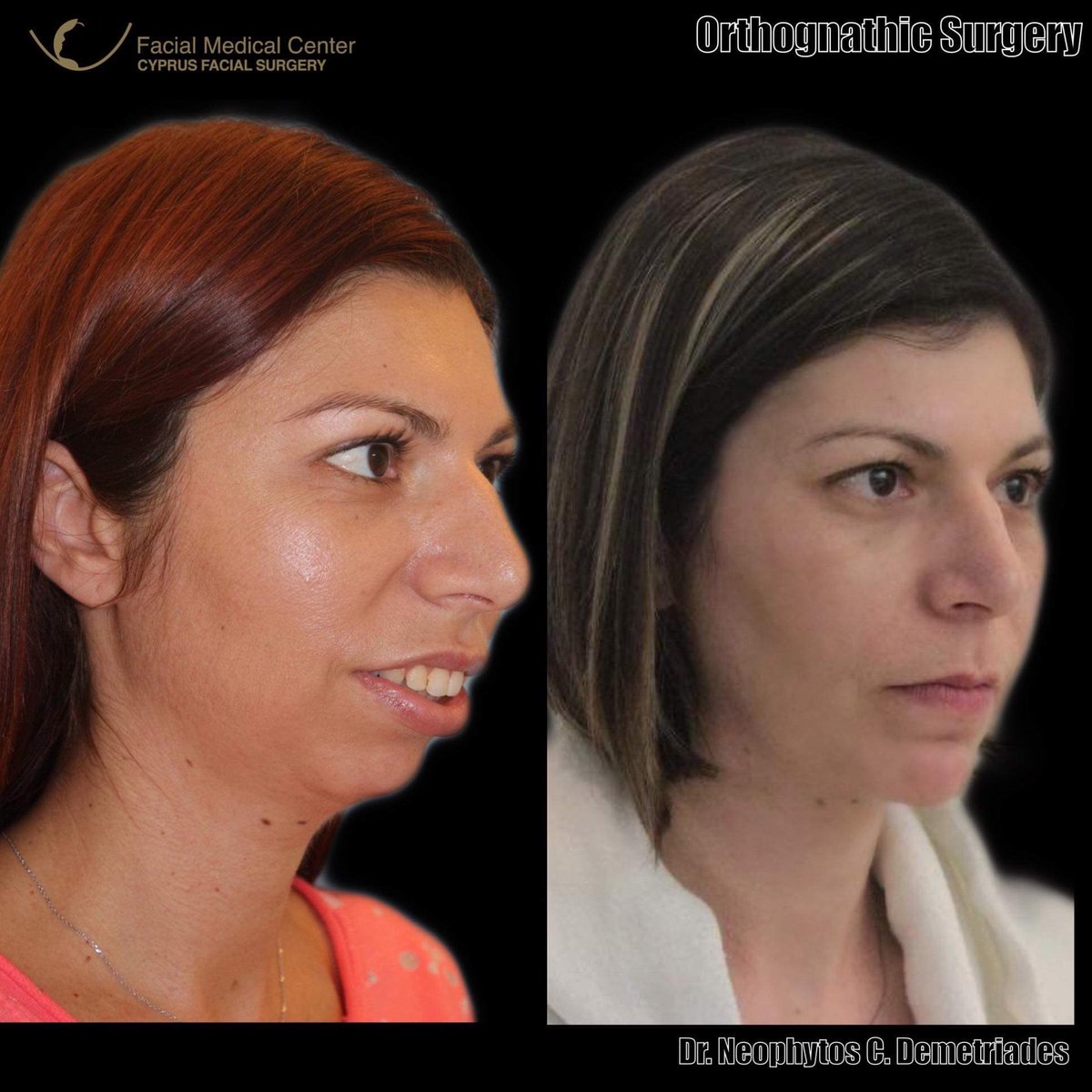 DemetriadesNeo's tweet photo. #cyprusfacialsurgery #facialcosmeticsurgery #oralandmaxillofacialsurgery #DrNeophytosDemetriades 
#weloveyourfacemorethanyoudo
#orthognathicsurgery  #facialcosmeticsurgerycyprus #jawcorrection #jawsurgery #newstylelift #facelift #nosejob #fillers #blepharoplasty https://t.co/ERrZ7iVNvr