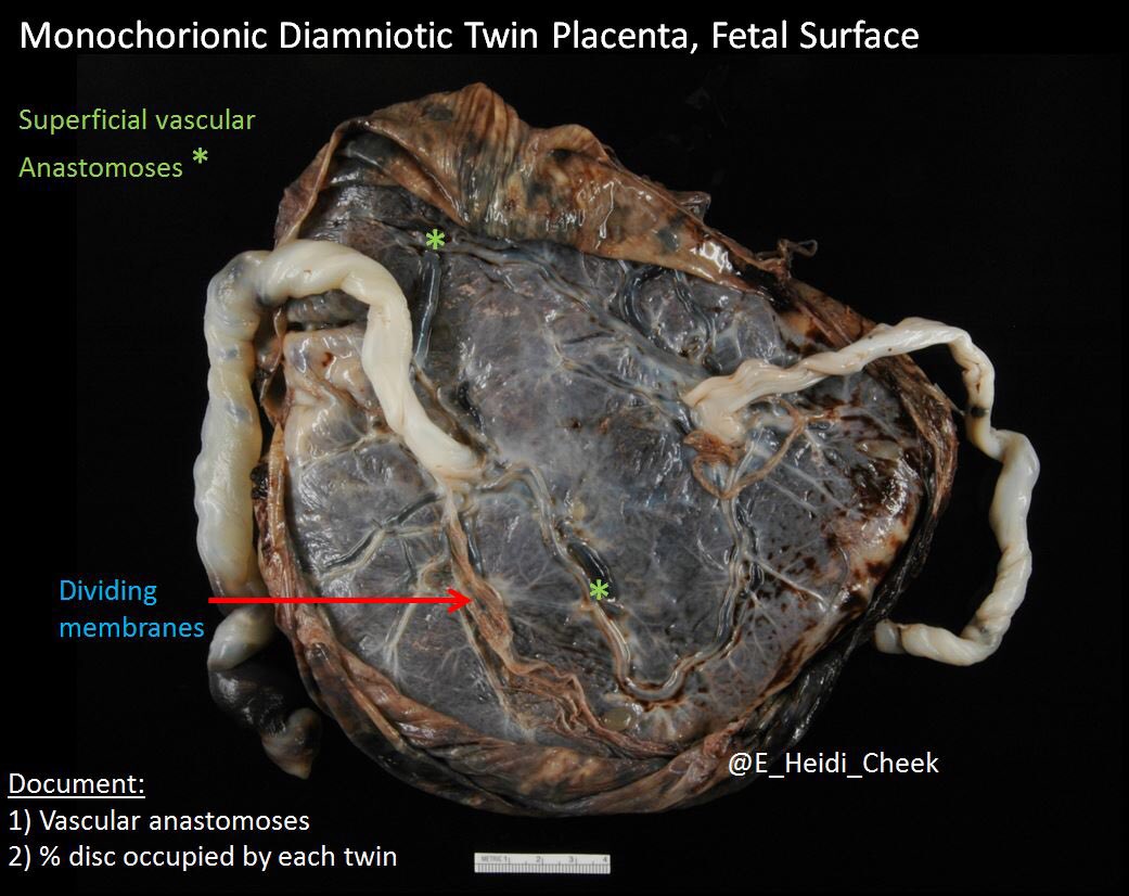 E. Heidi Cheek, MHS, PA(ASCP) tweet media
