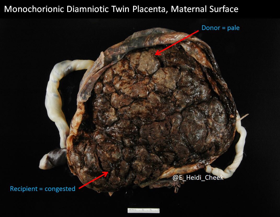 E. Heidi Cheek, MHS, PA(ASCP) tweet media